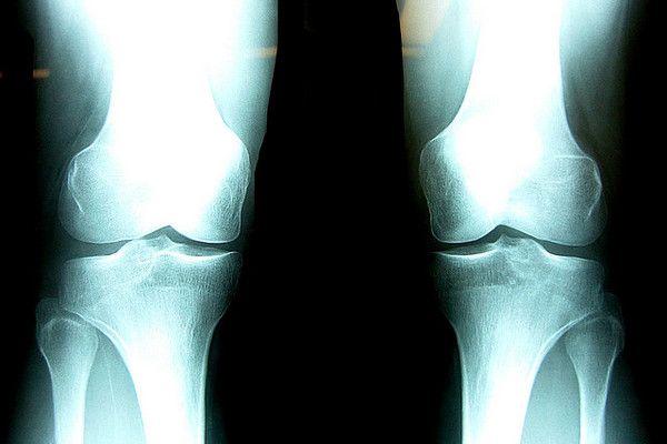 PCL Reconstruction: A Promising Solution for a Lesser Known Knee Injury