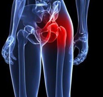 FAQs About Hip Impingement